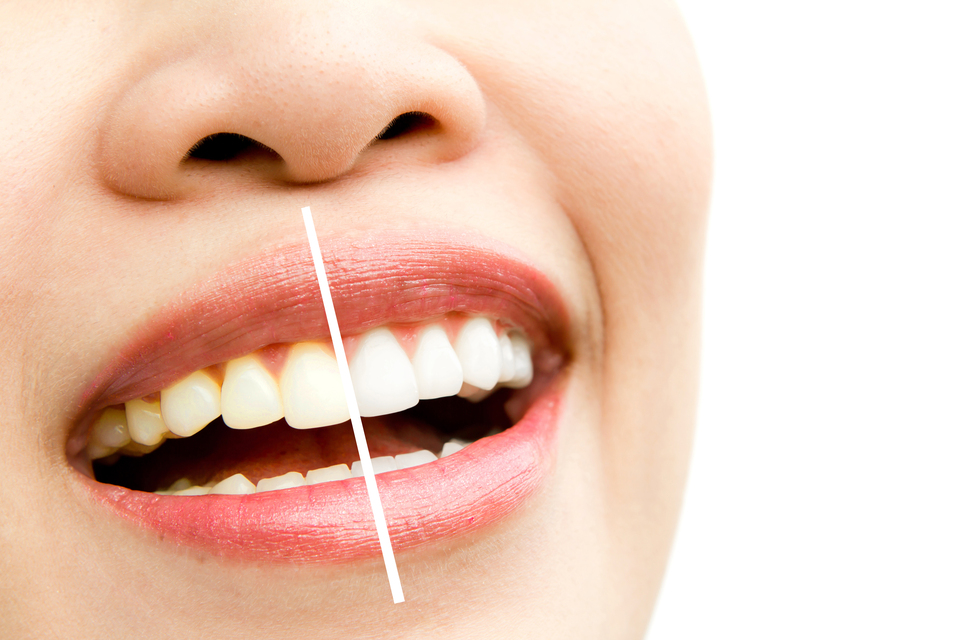 5 solutions to get your perfectly pearly smile,