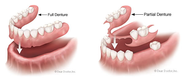 Removable acrylic partial dentures.