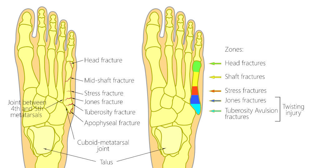 There are many types of foot fractures, as