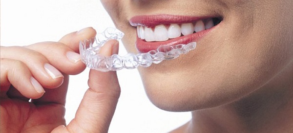 Forget the traditional braces. The still new alternative